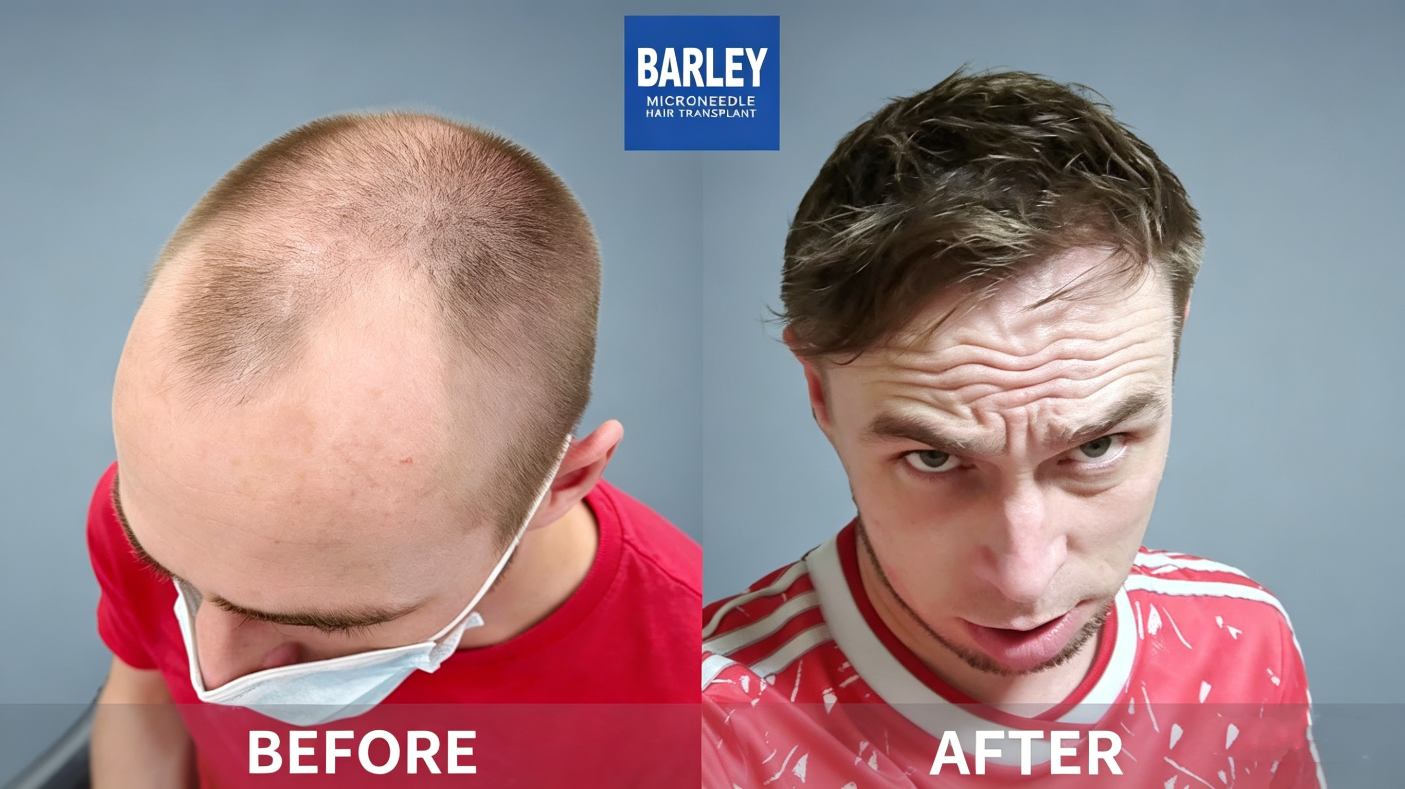 Barley Hair Transplant Hospital - Professional Hair Restoration Services