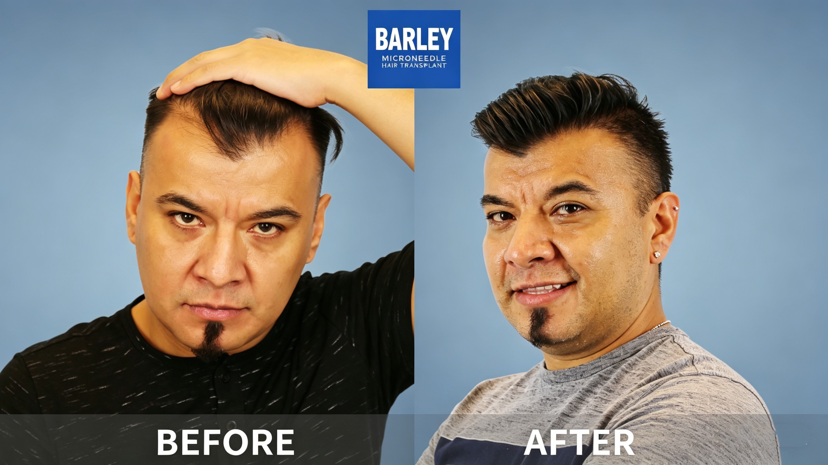Hair Transplant Services at Barley Hospital