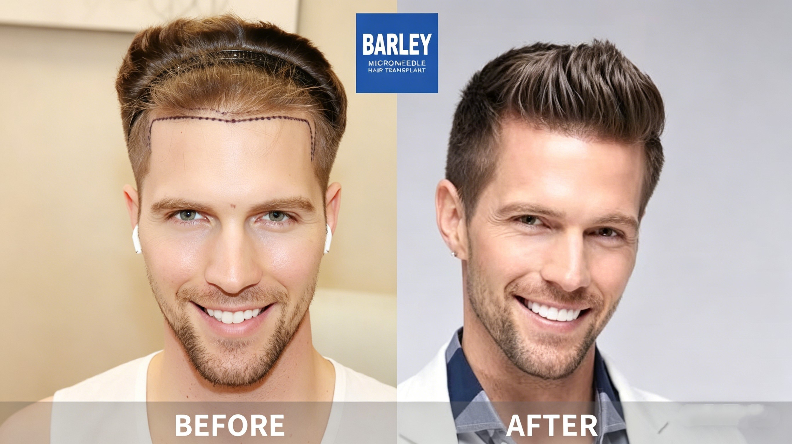 Recovery After Hair Transplant