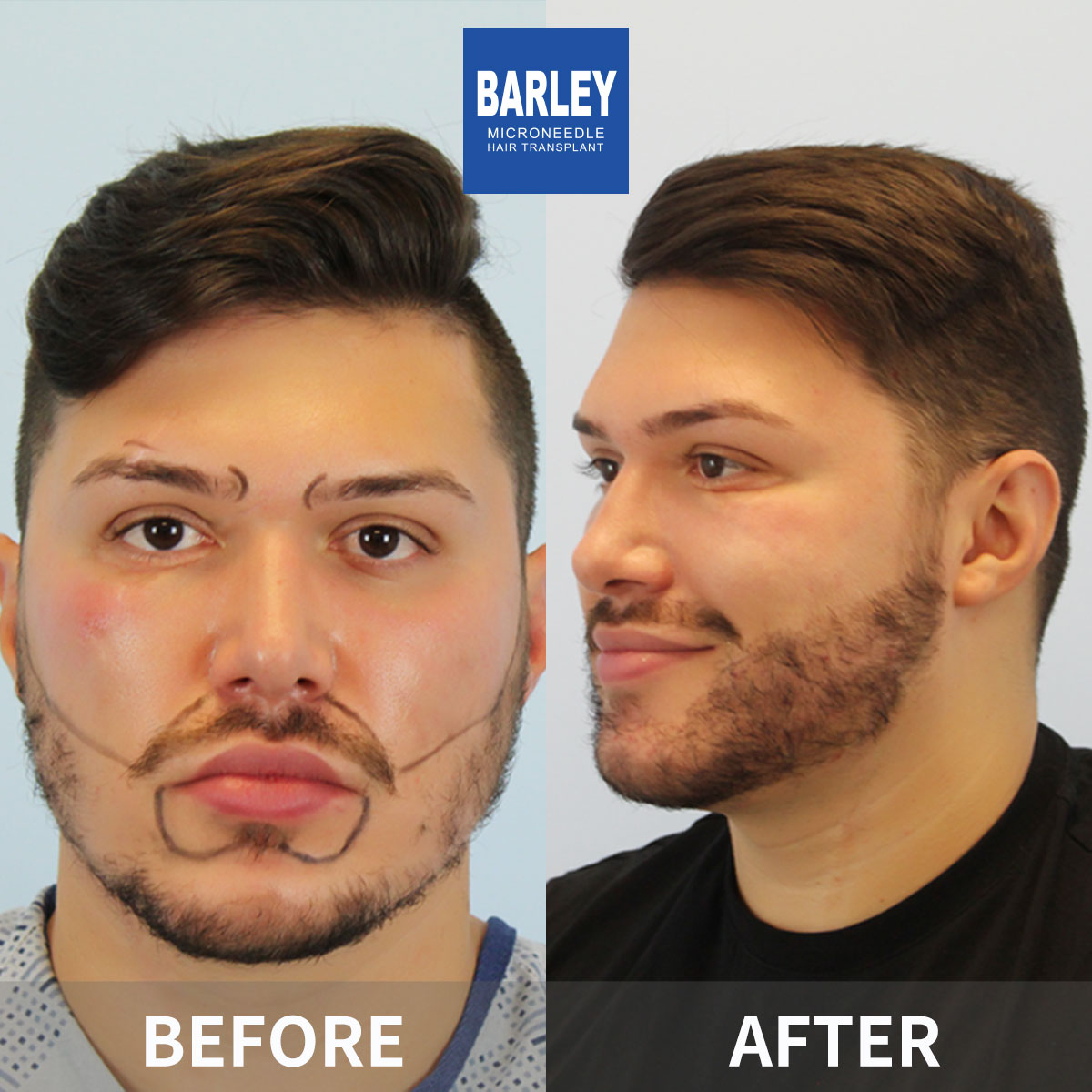 Beard transplant results