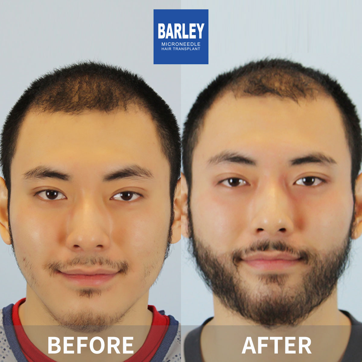 Beard transplant results