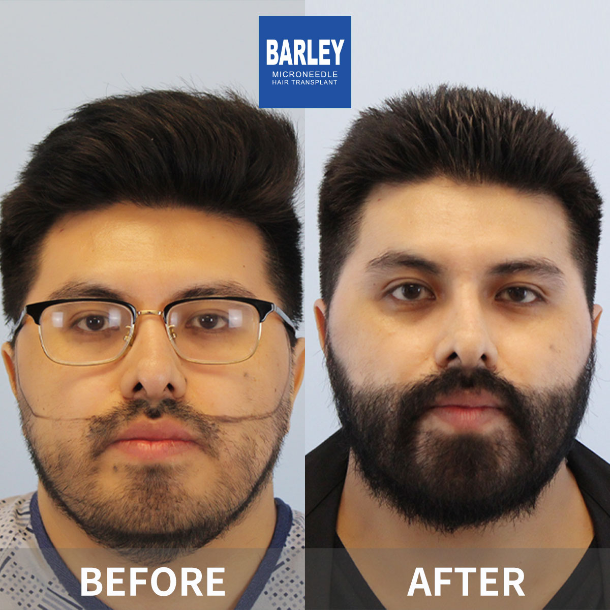 Beard transplant before and after