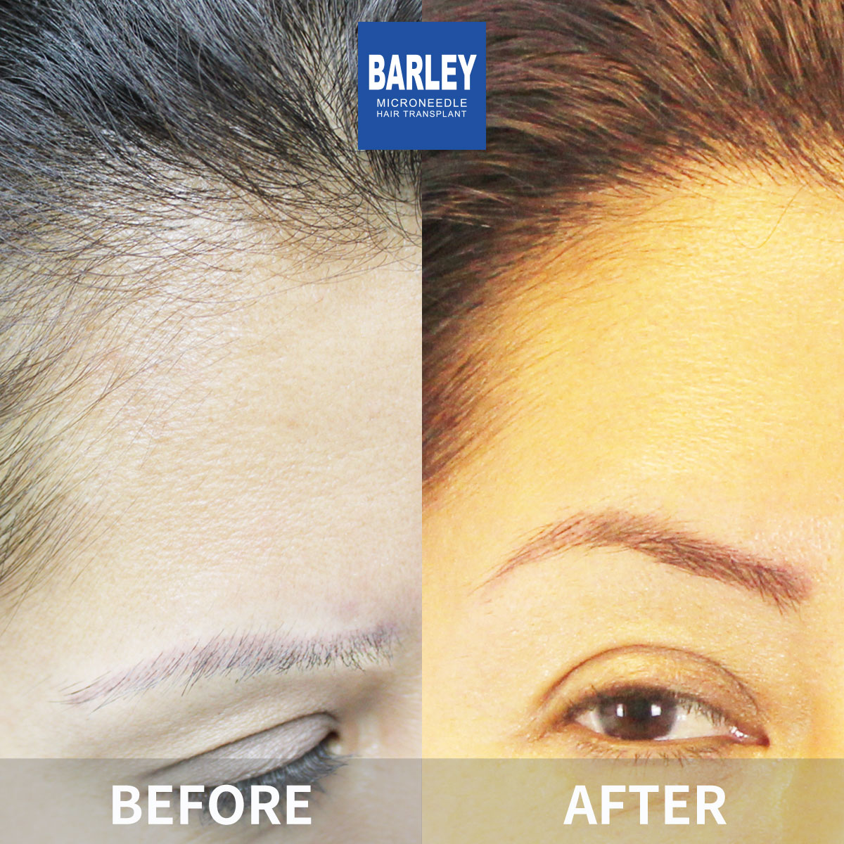 Eyebrow transplant before and after