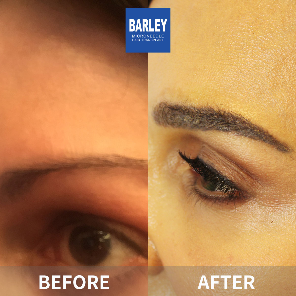 Eyebrow transplant before and after