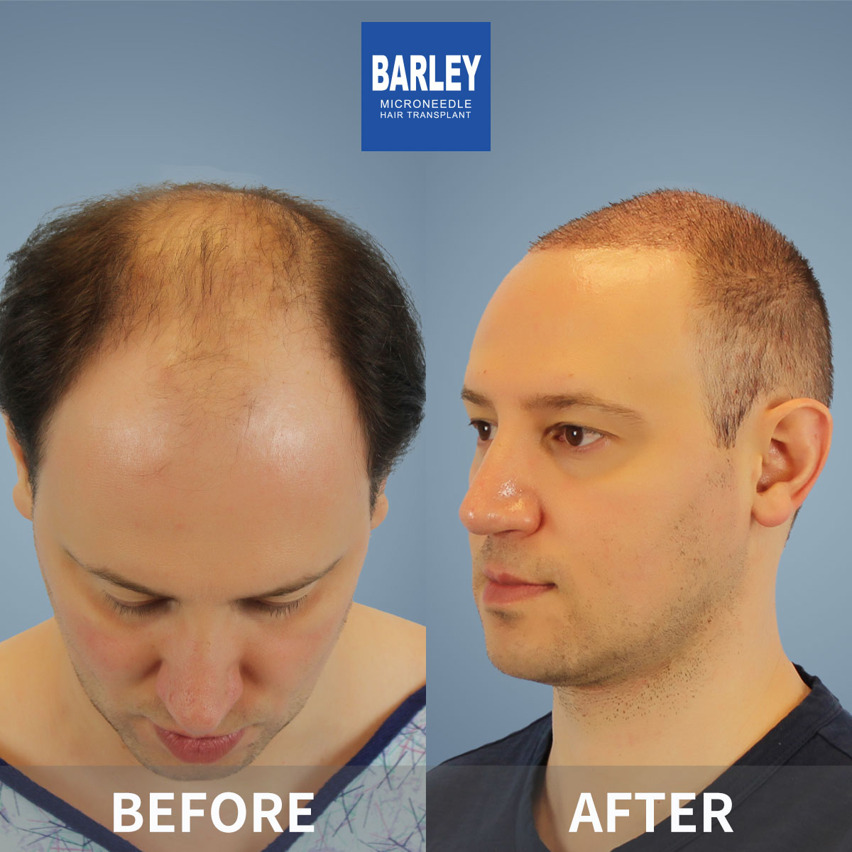 Baldness treatment results