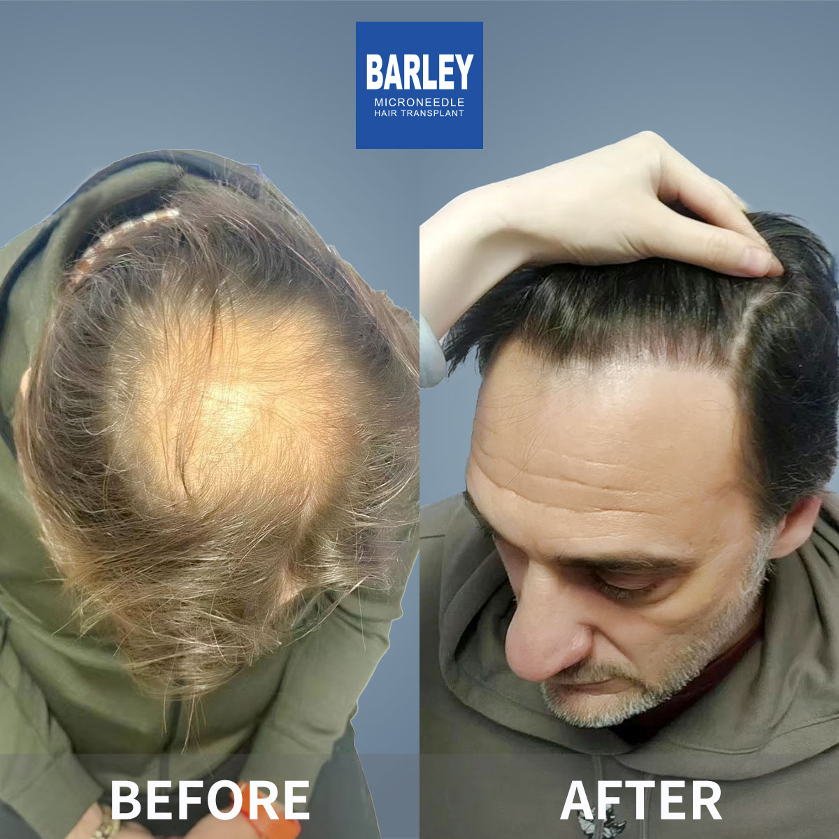 Baldness treatment before and after