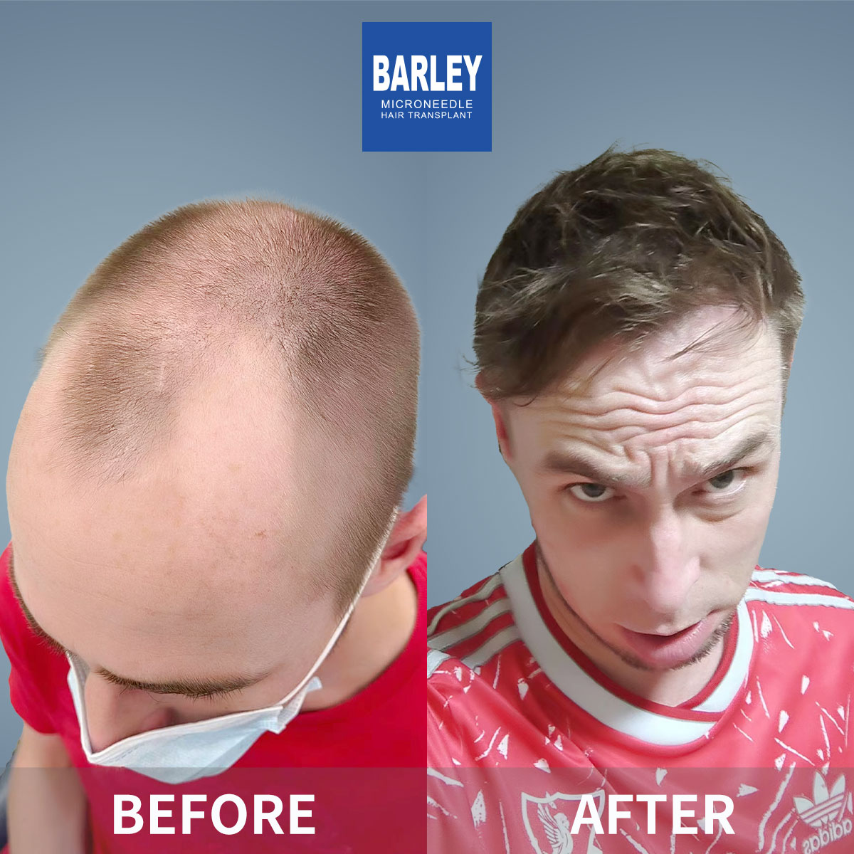 Baldness treatment before and after