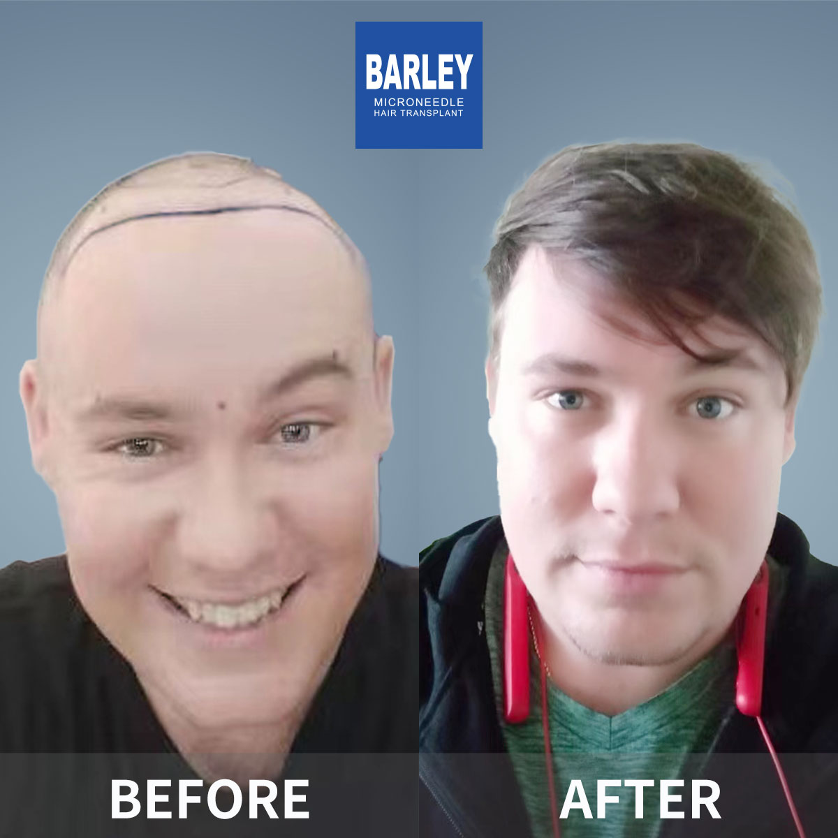 Baldness treatment before and after