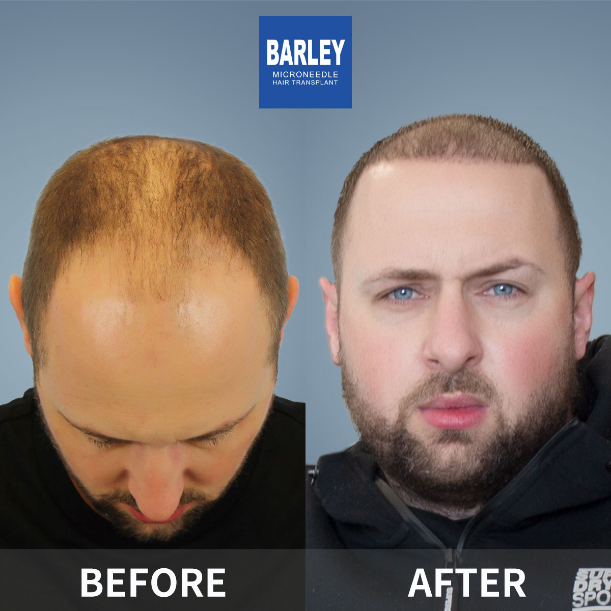 Baldness treatment results