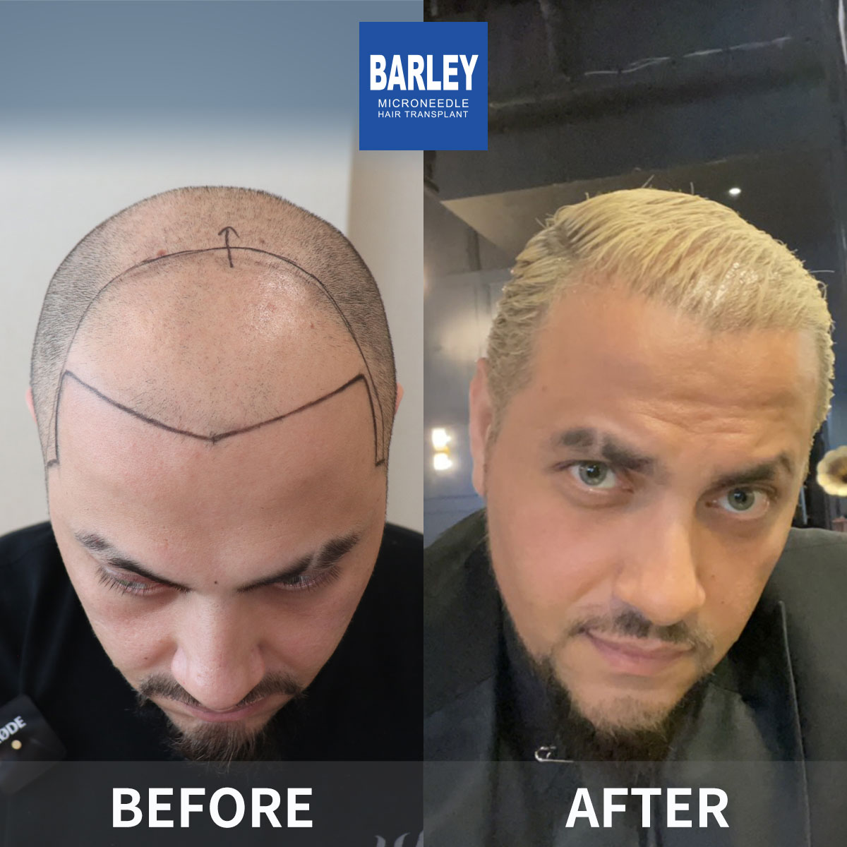 Baldness treatment before and after