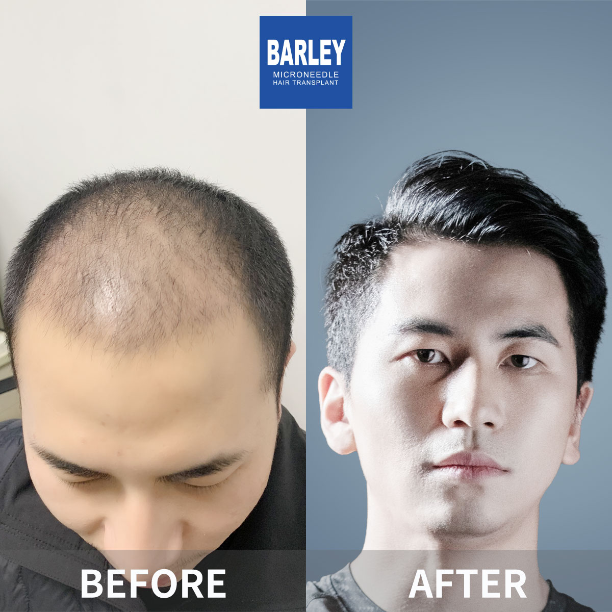 Baldness treatment before and after