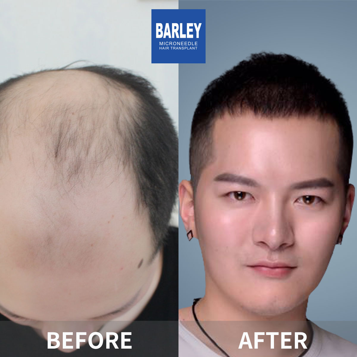 Baldness treatment before and after