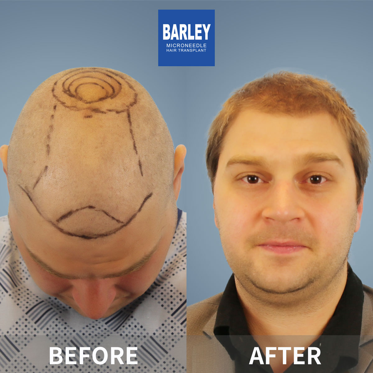 Baldness treatment before and after