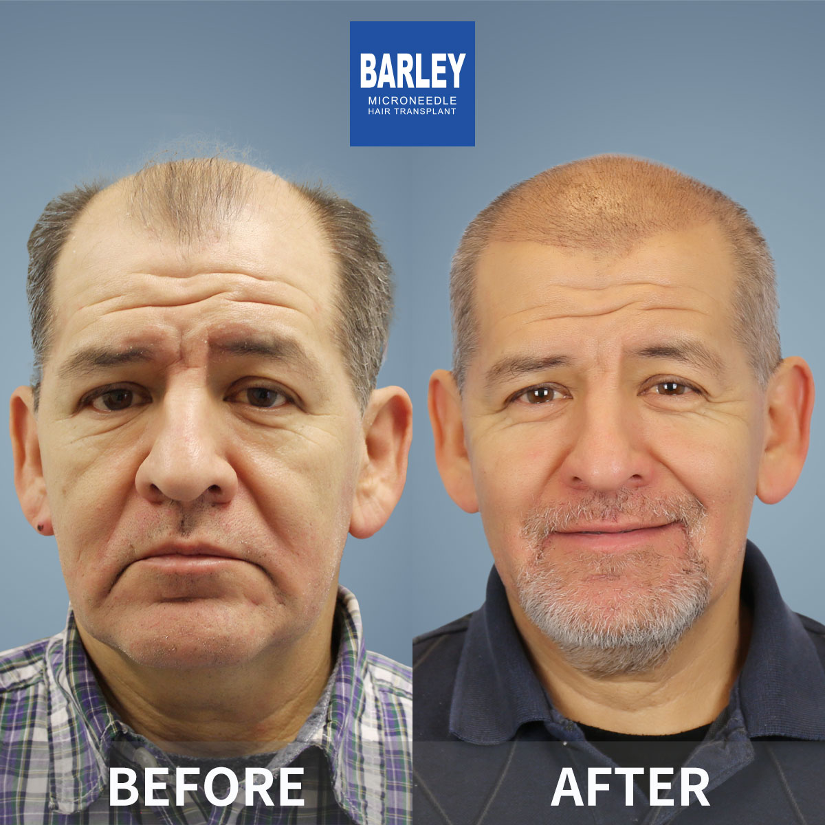 Hair loss treatment results