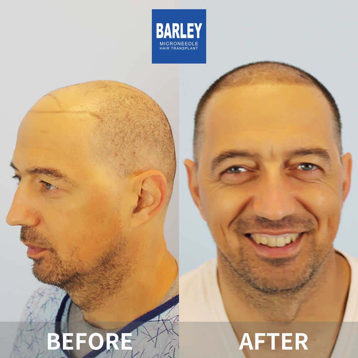 Baldness treatment before and after