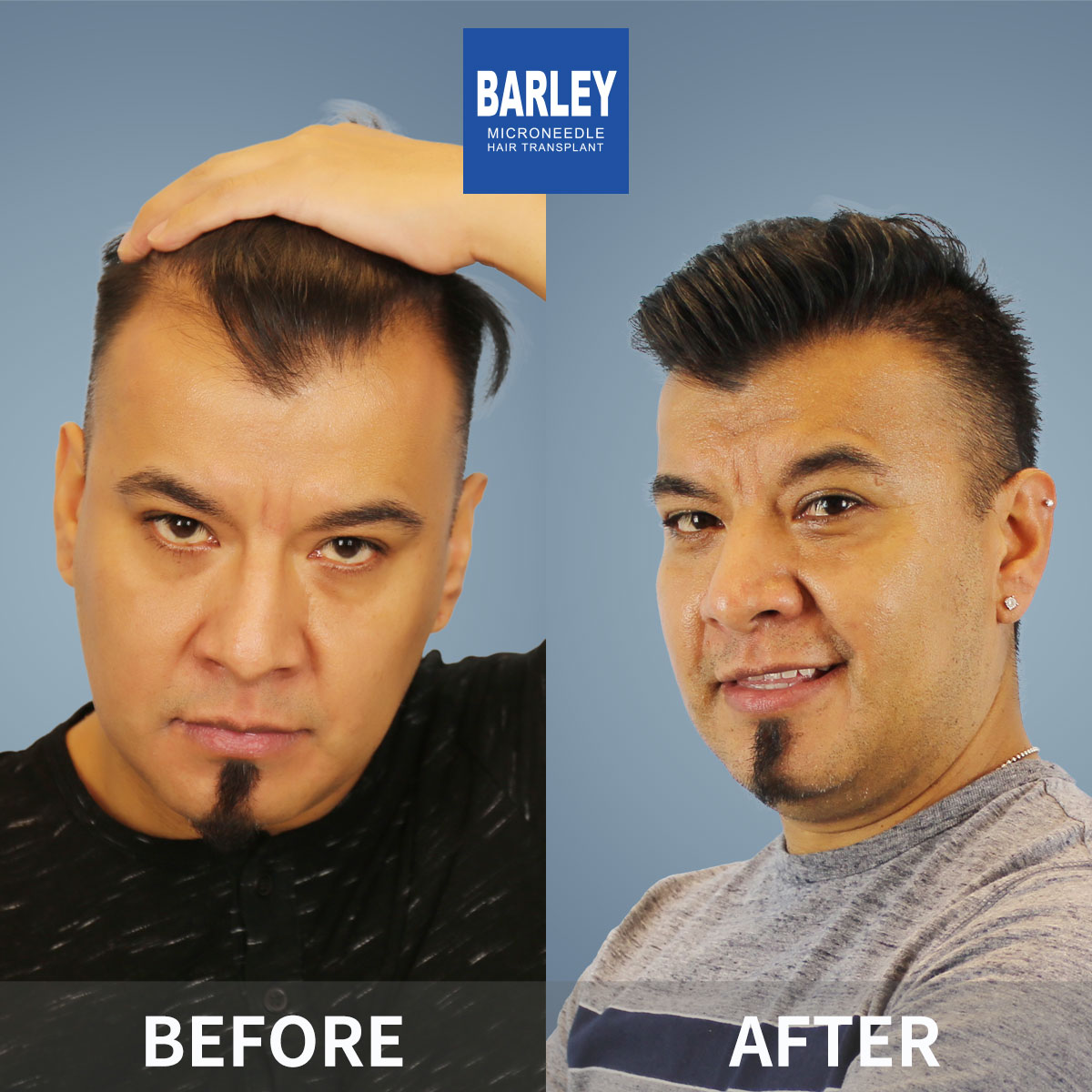 Hair transplant before and after