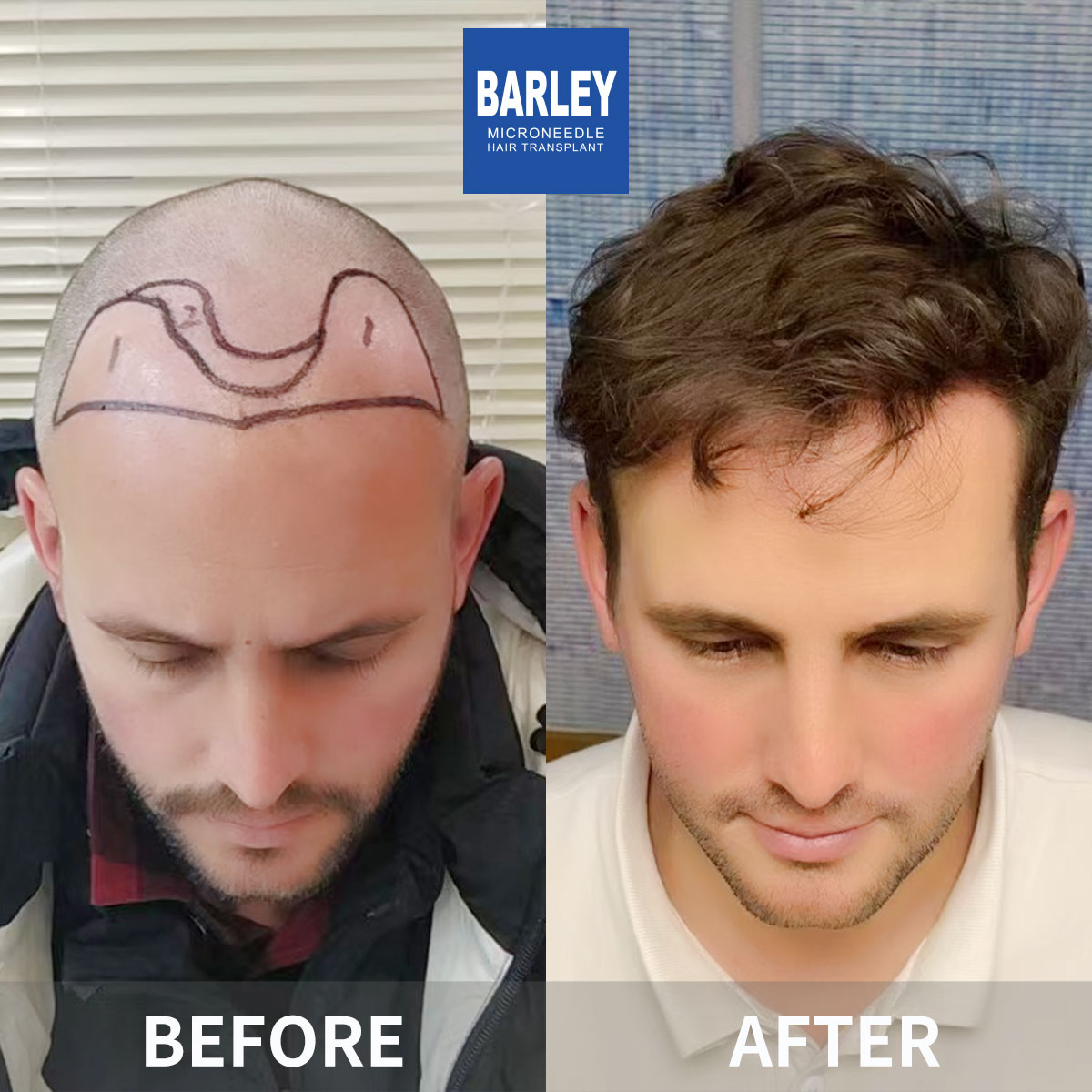 Hairline transplant before and after