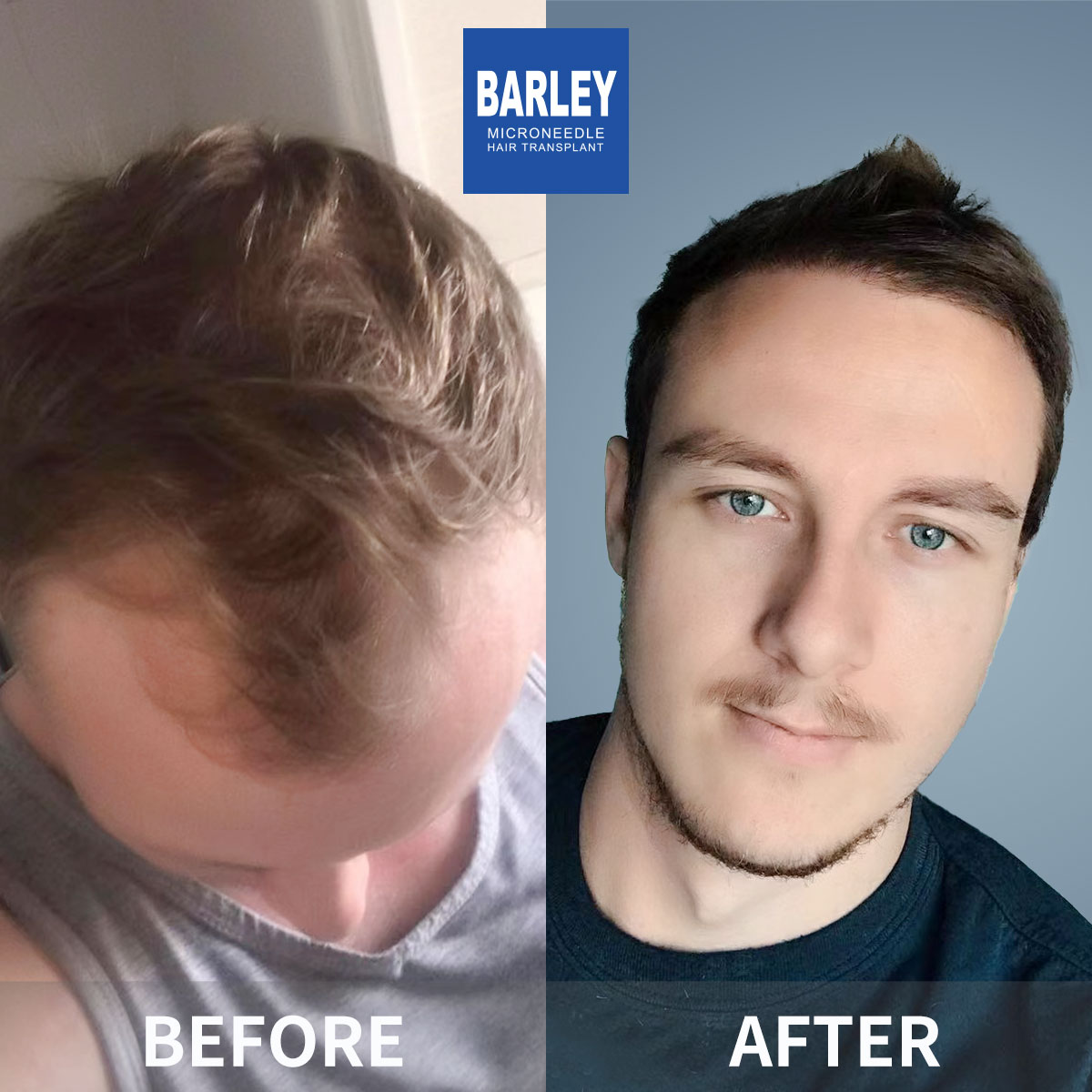 Hairline transplant before and after