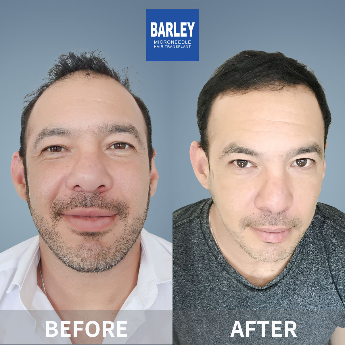 Hairline transplant before and after