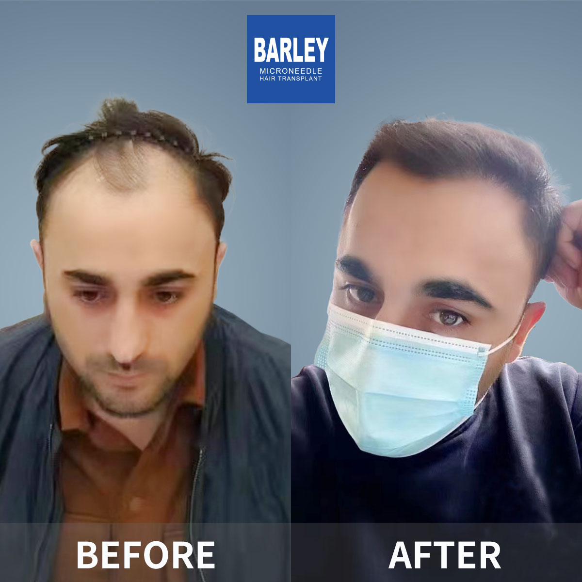 Hairline transplant before and after