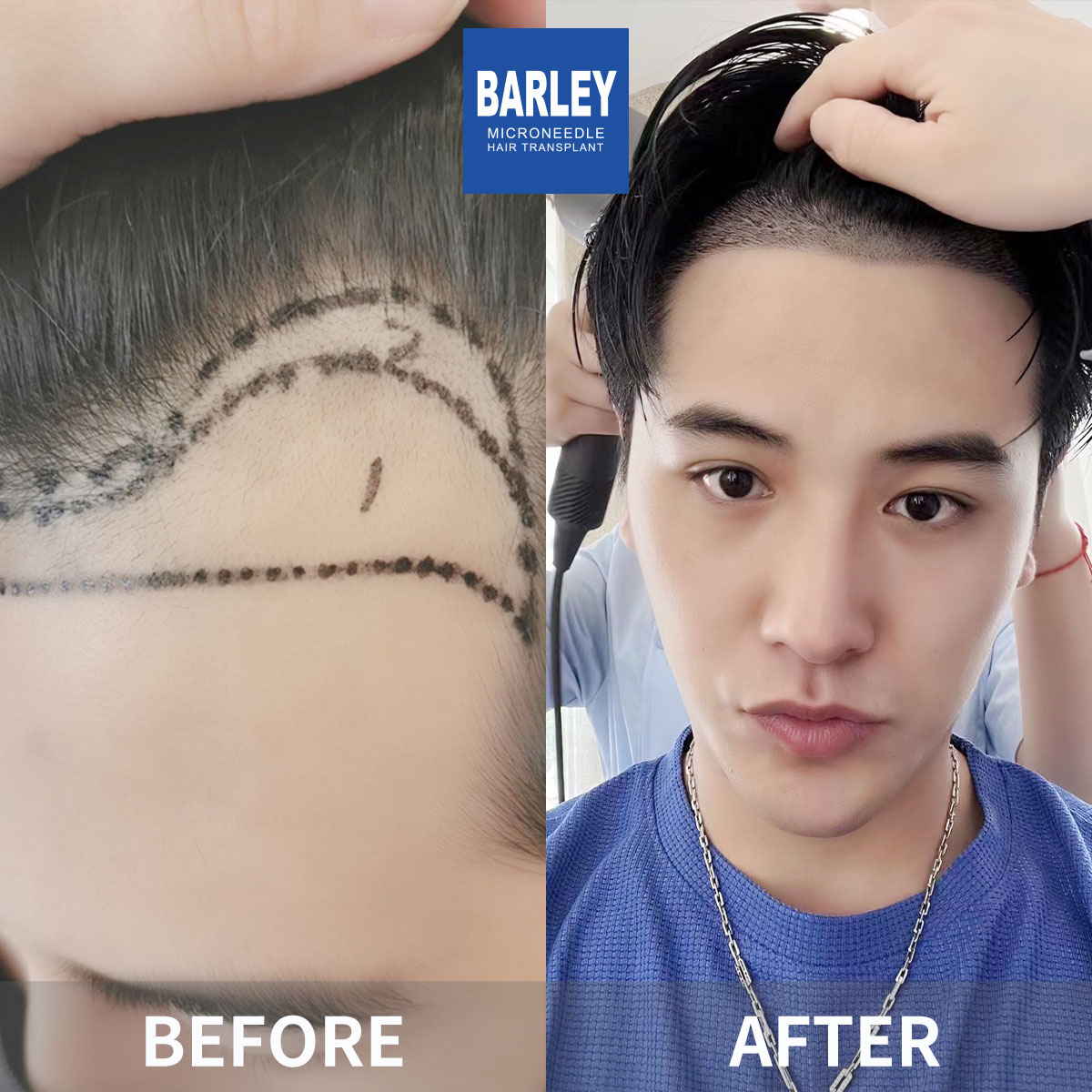 Hairline transplant before and after