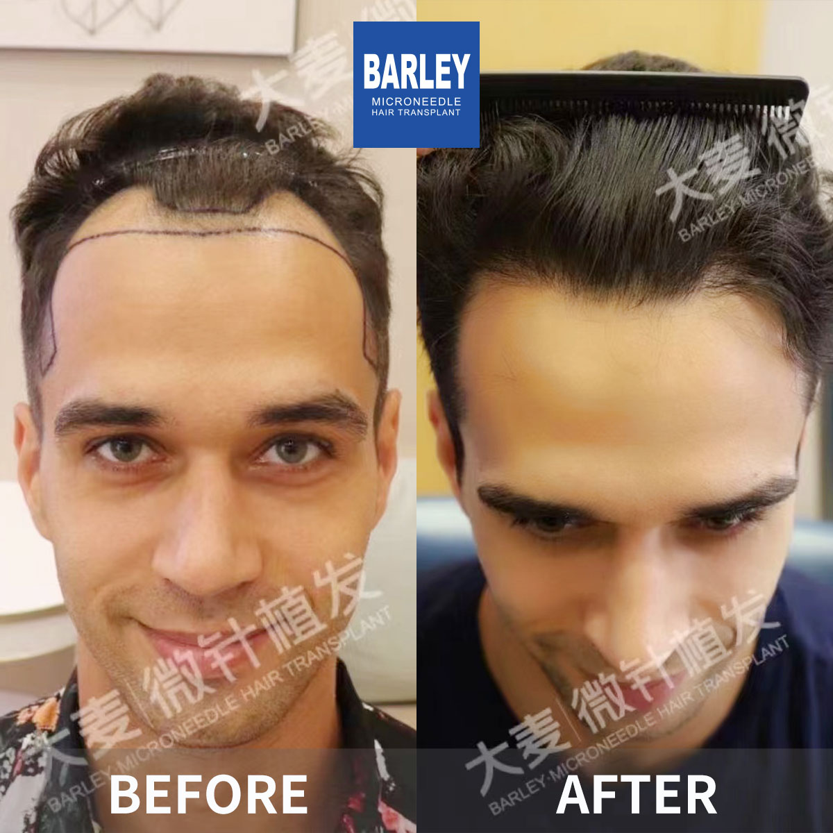 Hairline transplant before and after