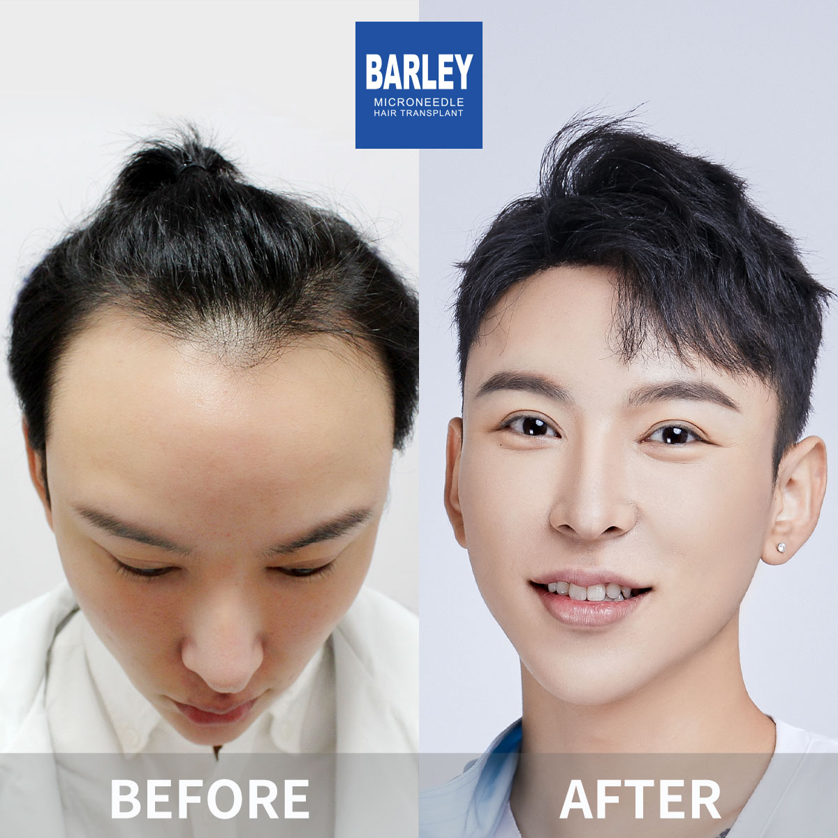Hairline transplant before and after