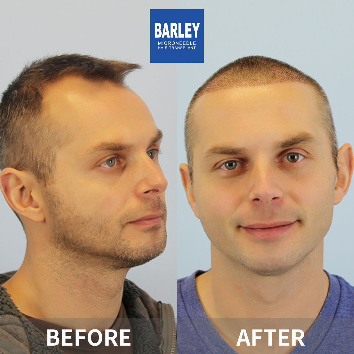 Hairline transplant before and after