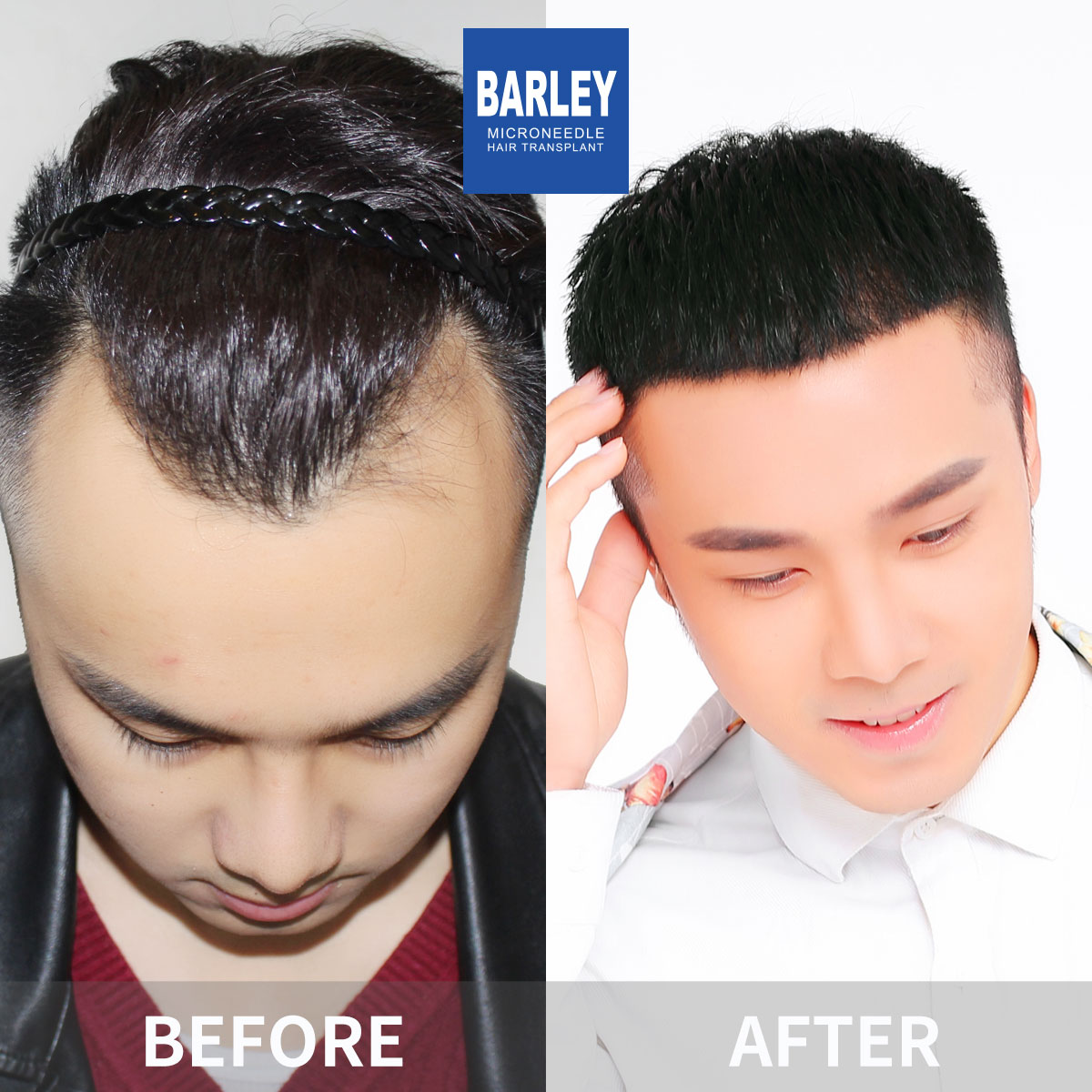 Hairline transplant before and after