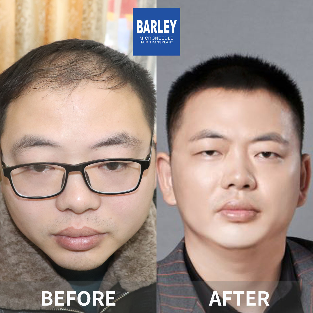 Hairline transplant before and after