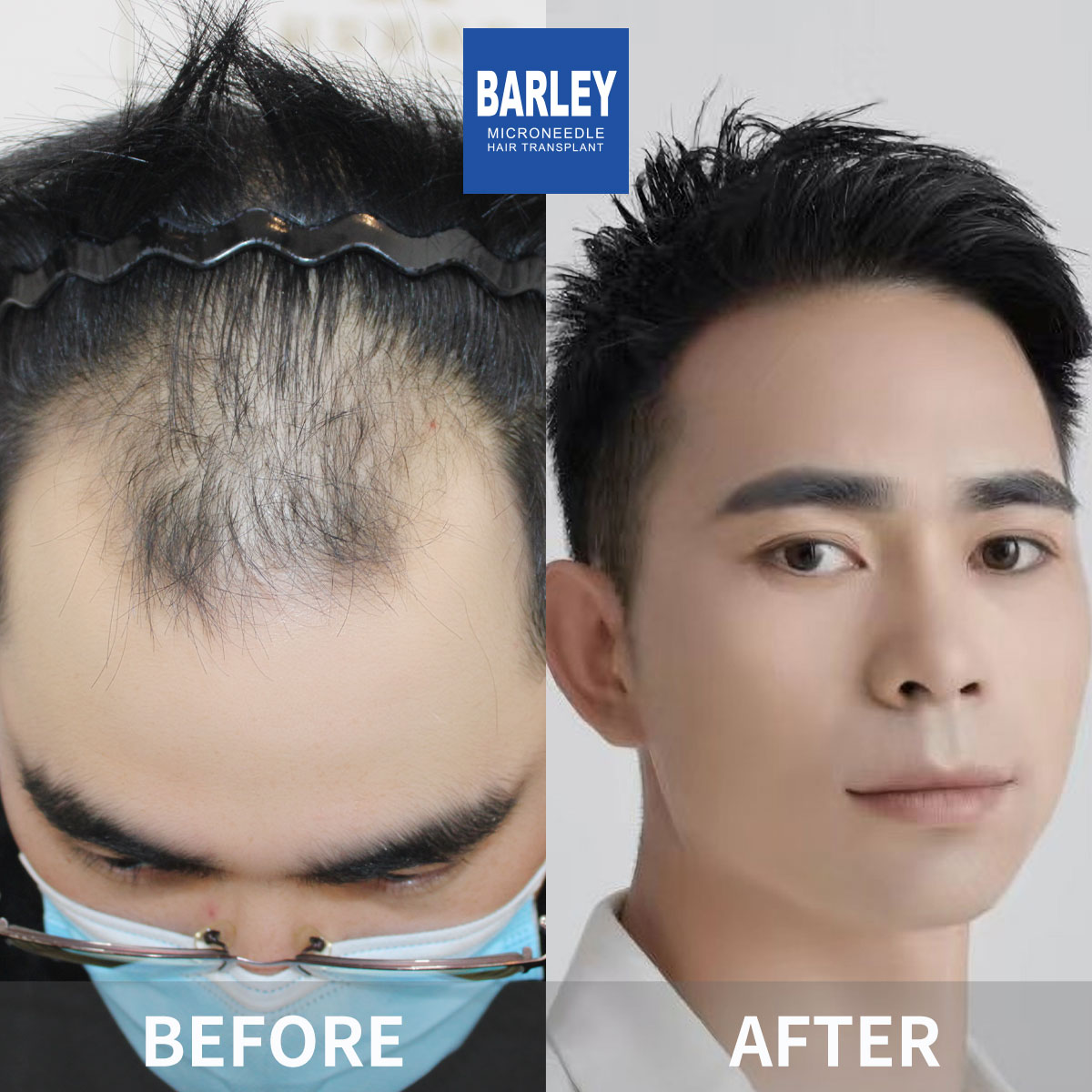 Hairline transplant before and after