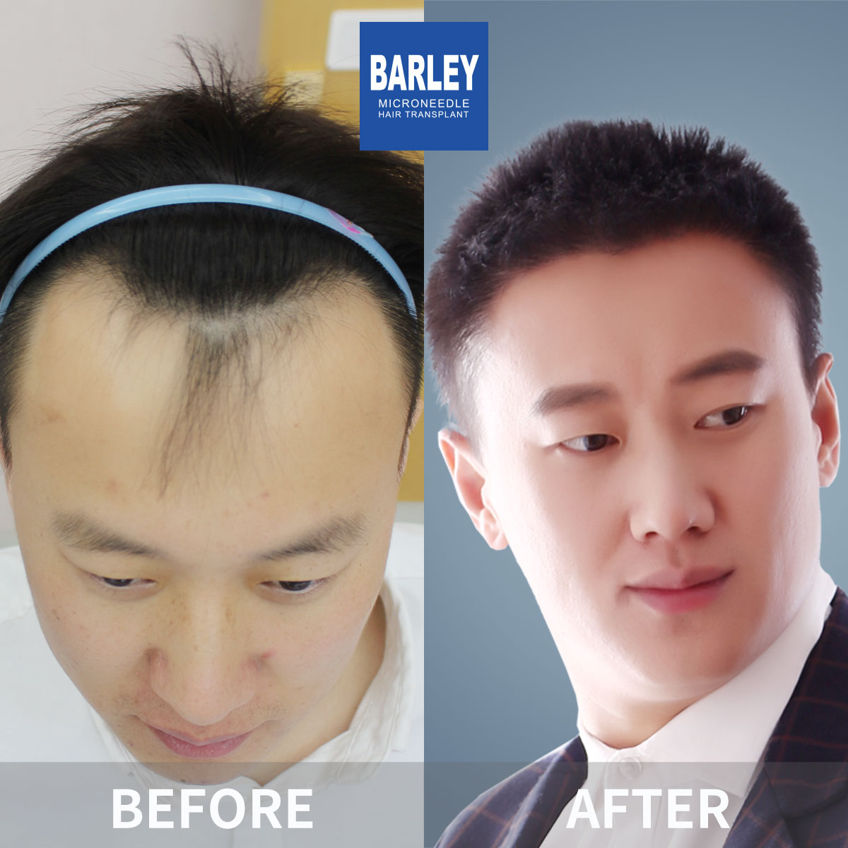 Hairline transplant before and after
