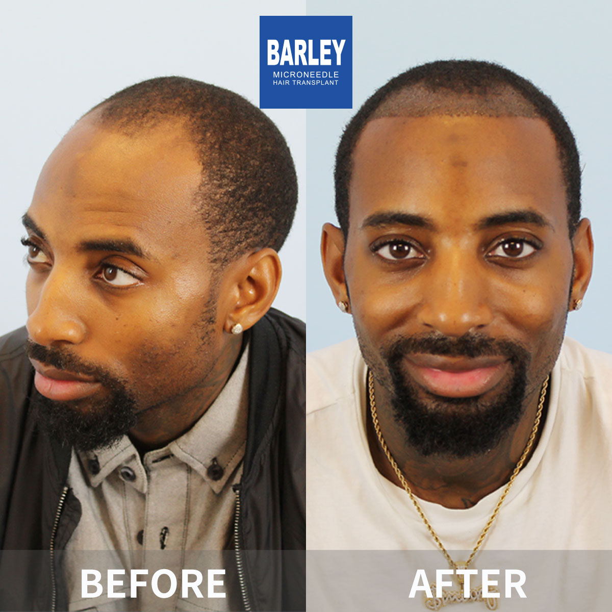 Hairline transplant before and after