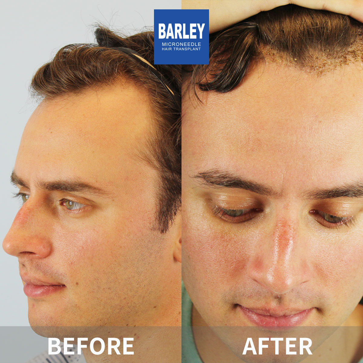 Hairline transplant before and after