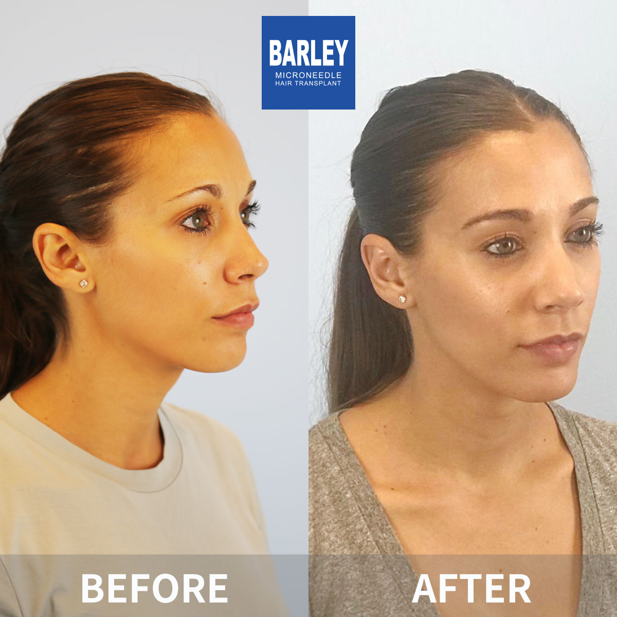 Female hair transplant results