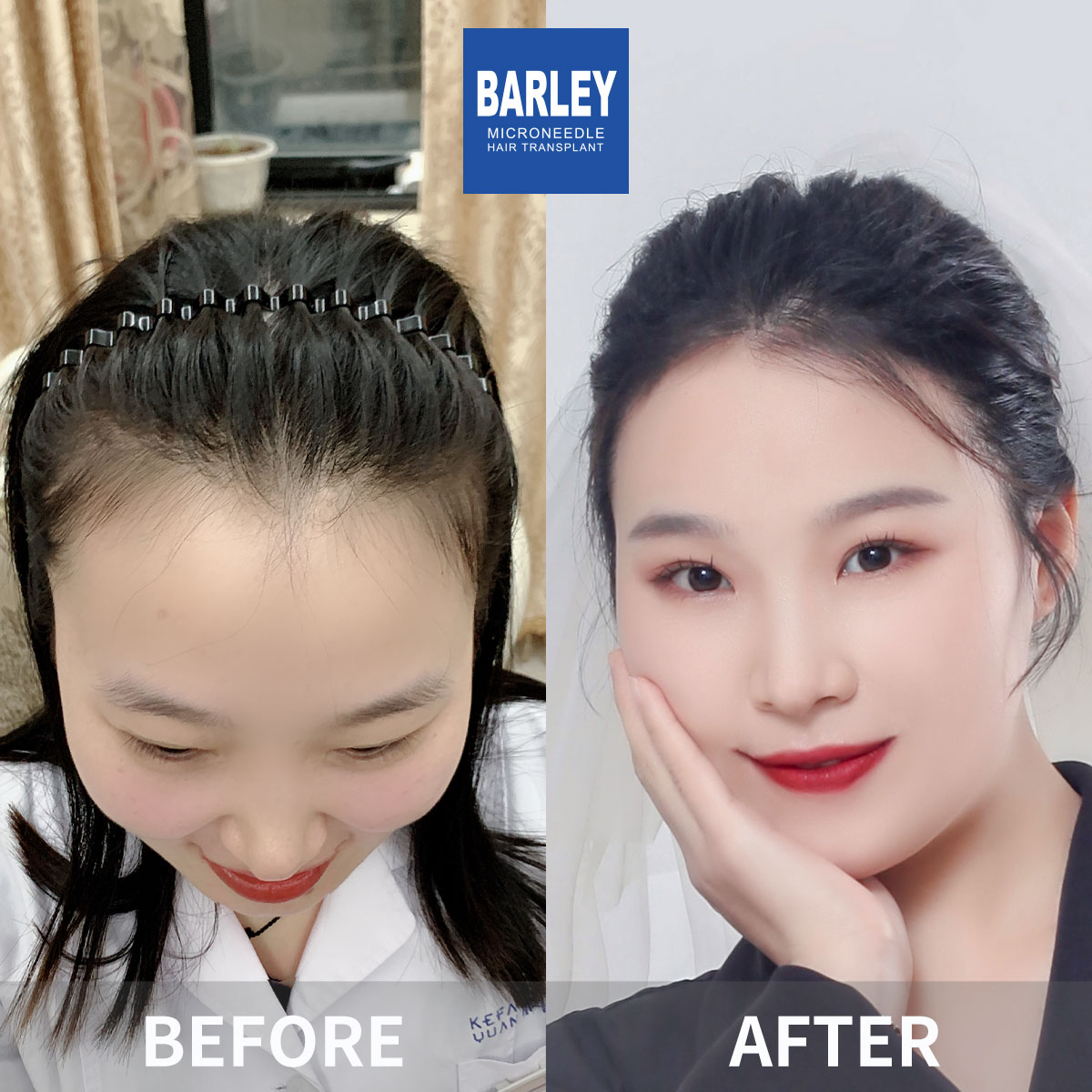 Female hair transplant before and after