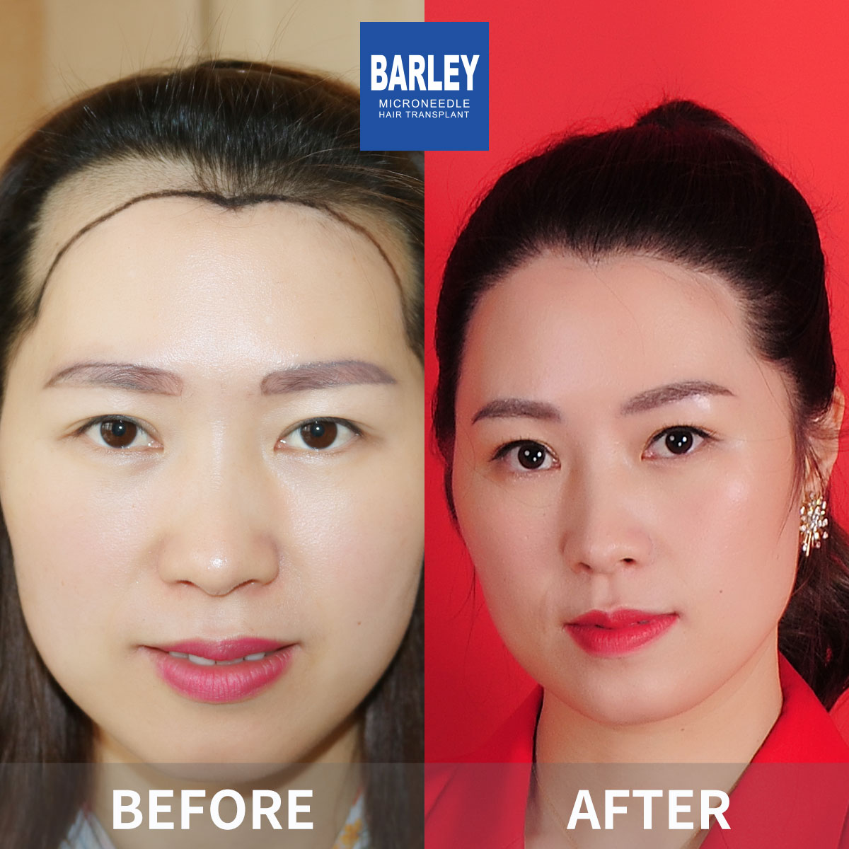 Female hair transplant before and after