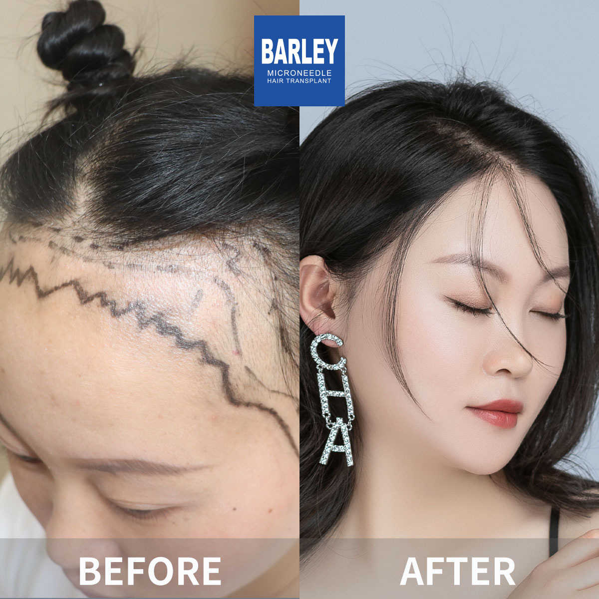 Female hair transplant before and after