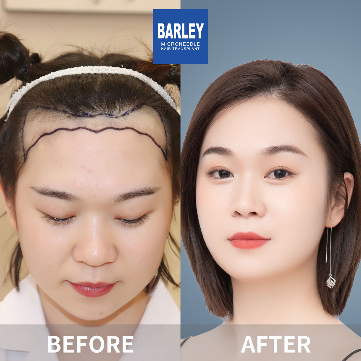 Female hair transplant before and after