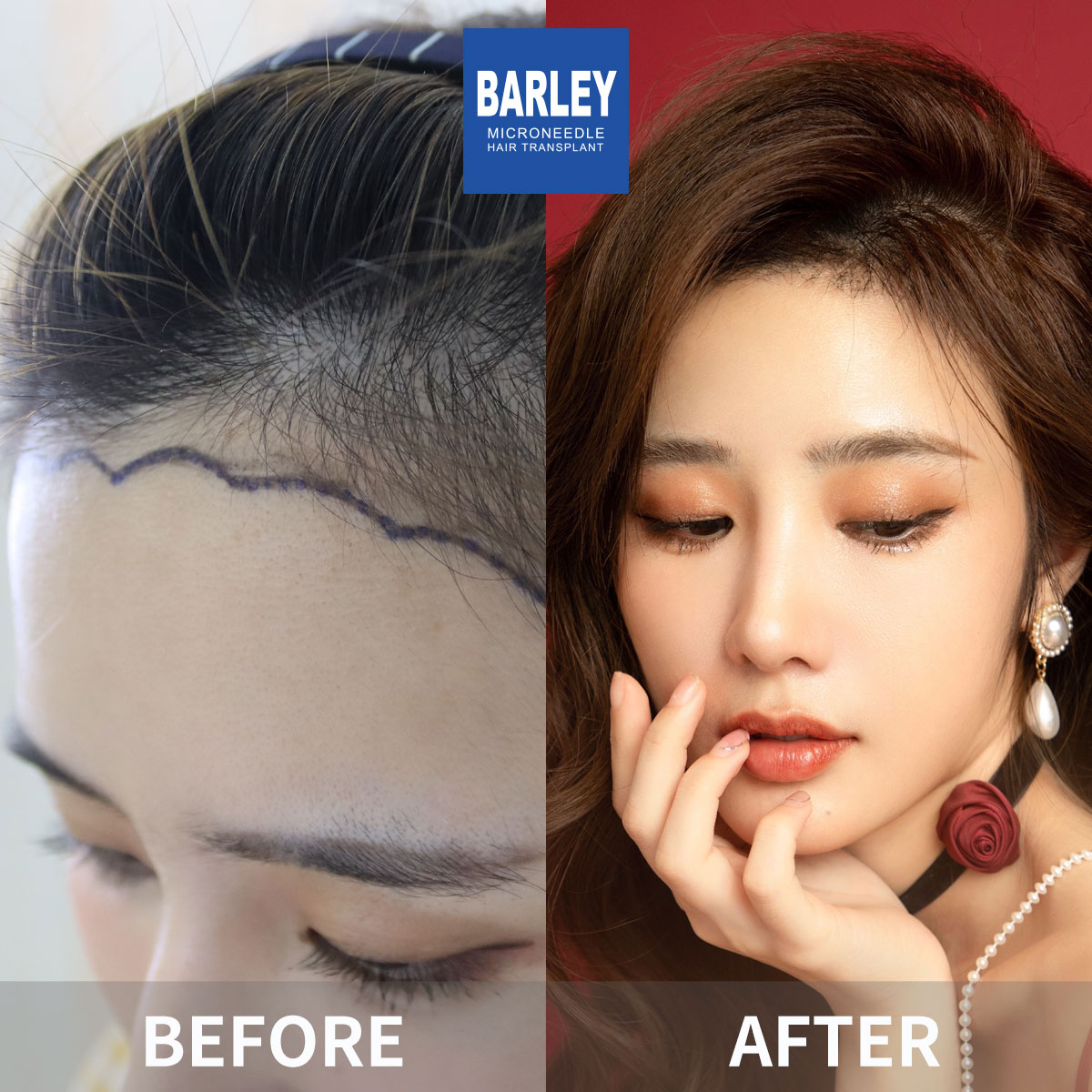 Female hair transplant before and after