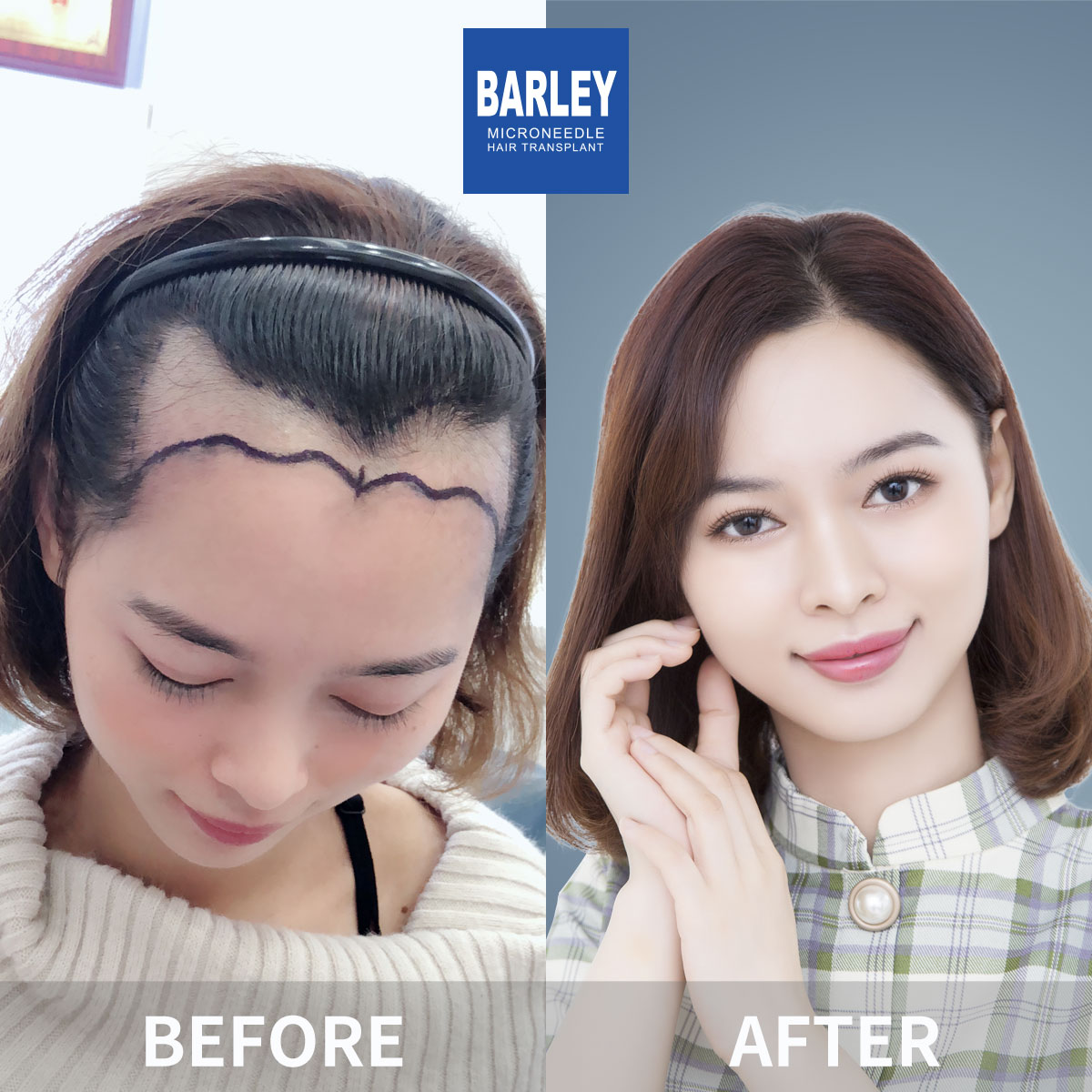 Female hair transplant before and after