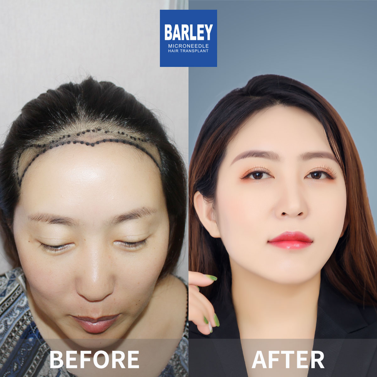 Female hair transplant before and after