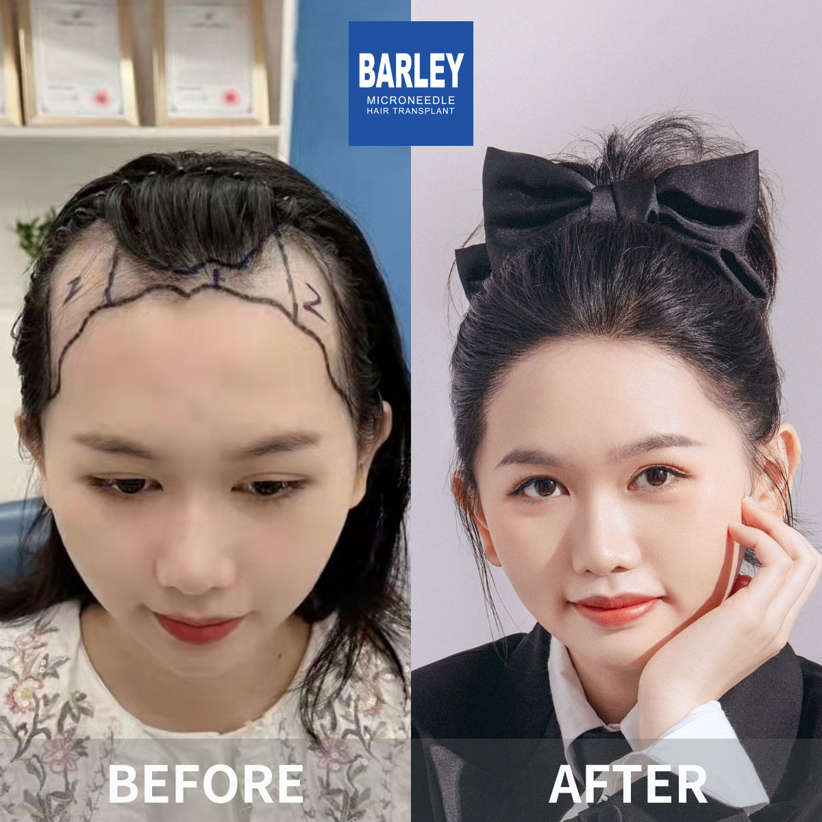 Female hair transplant before and after