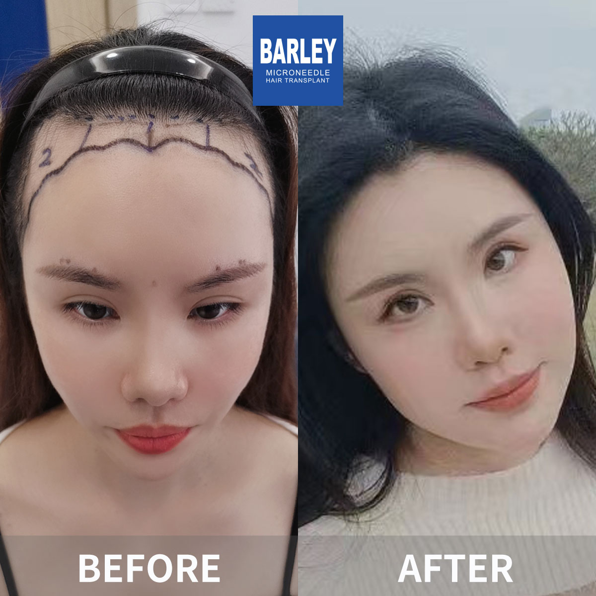 Female hair transplant before and after