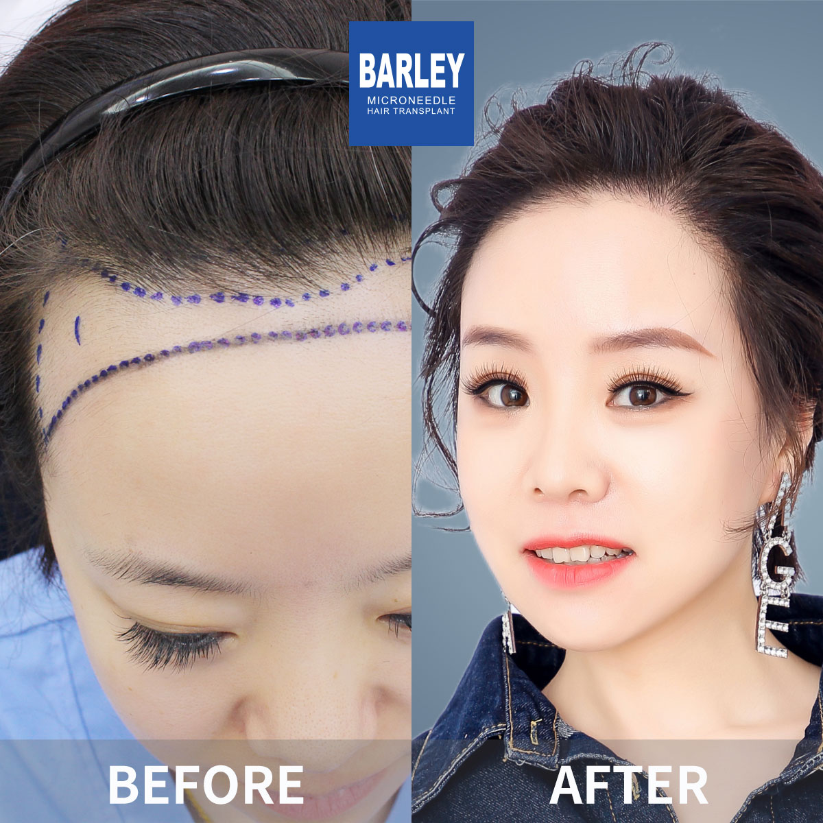 Female hair transplant before and after