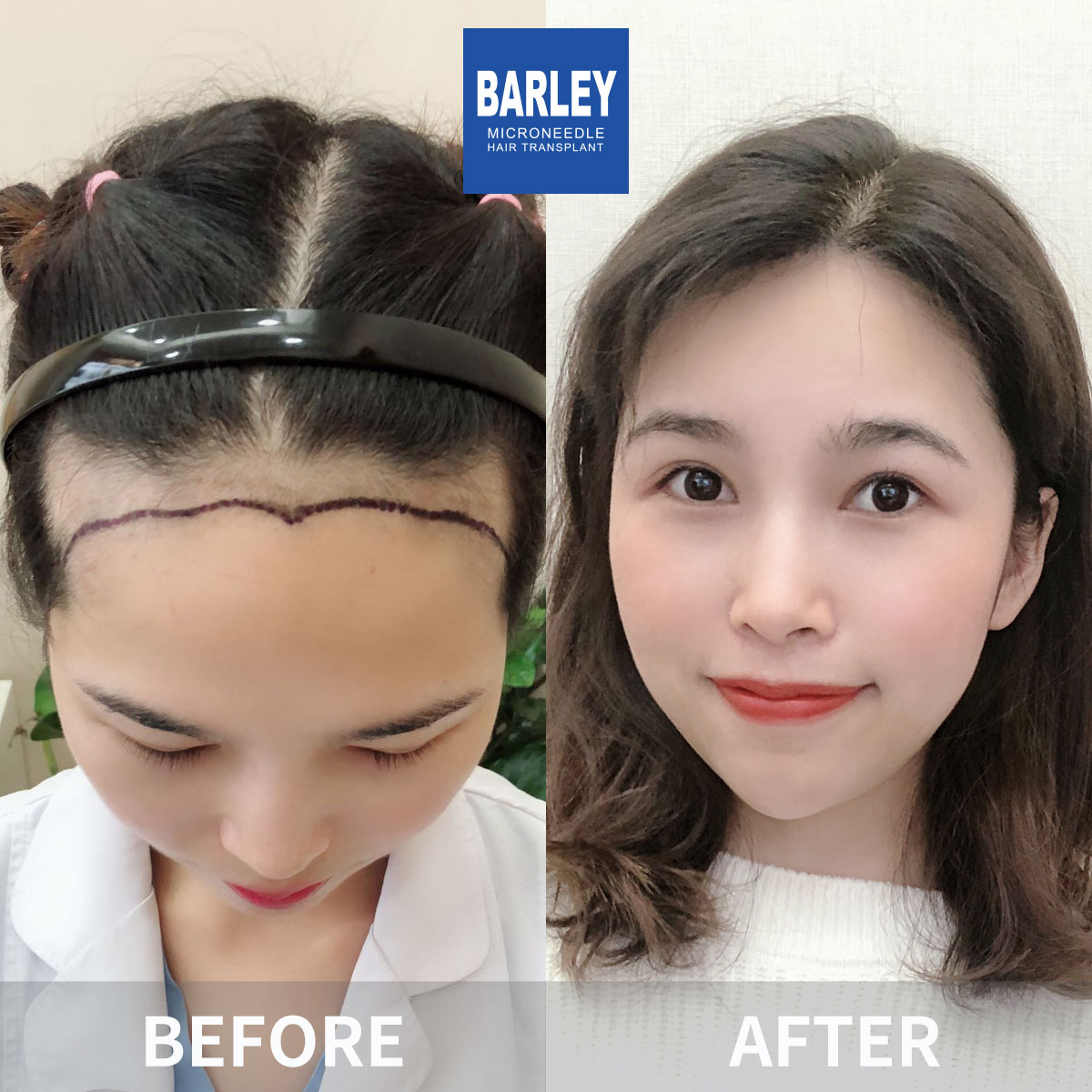Female hair transplant before and after