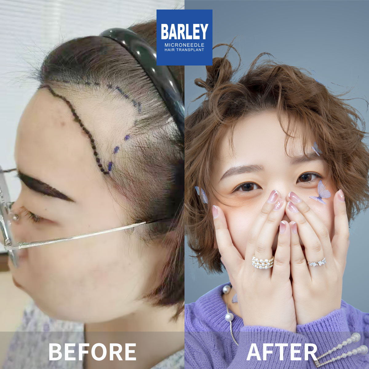 Female hair transplant before and after