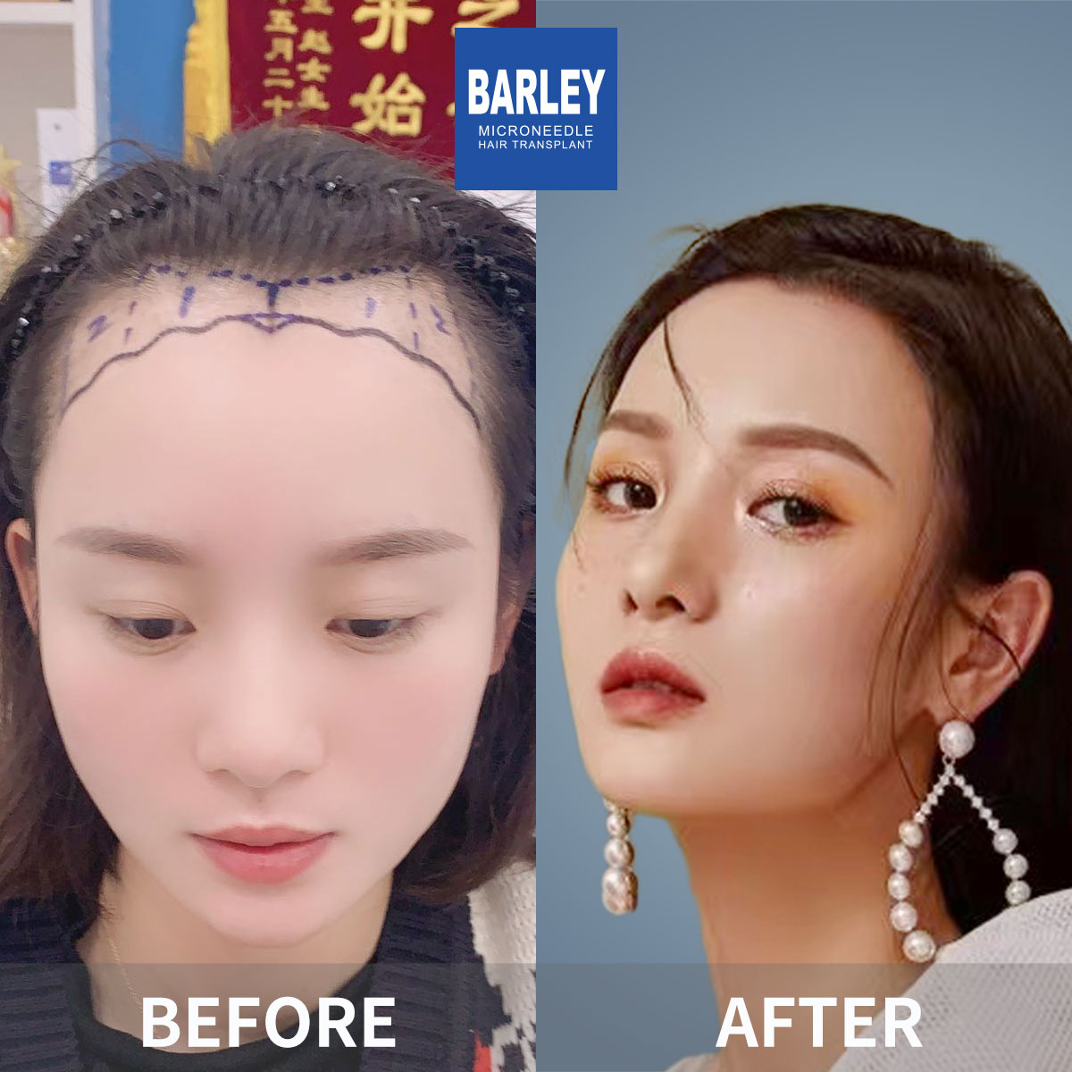 Female hair transplant before and after