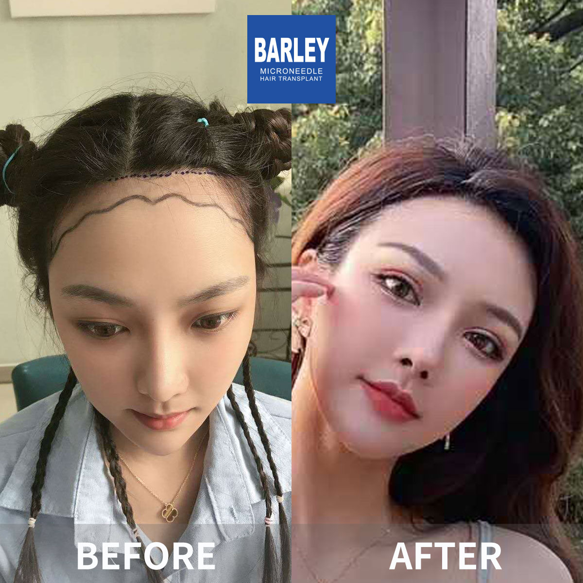 Female hair transplant before and after