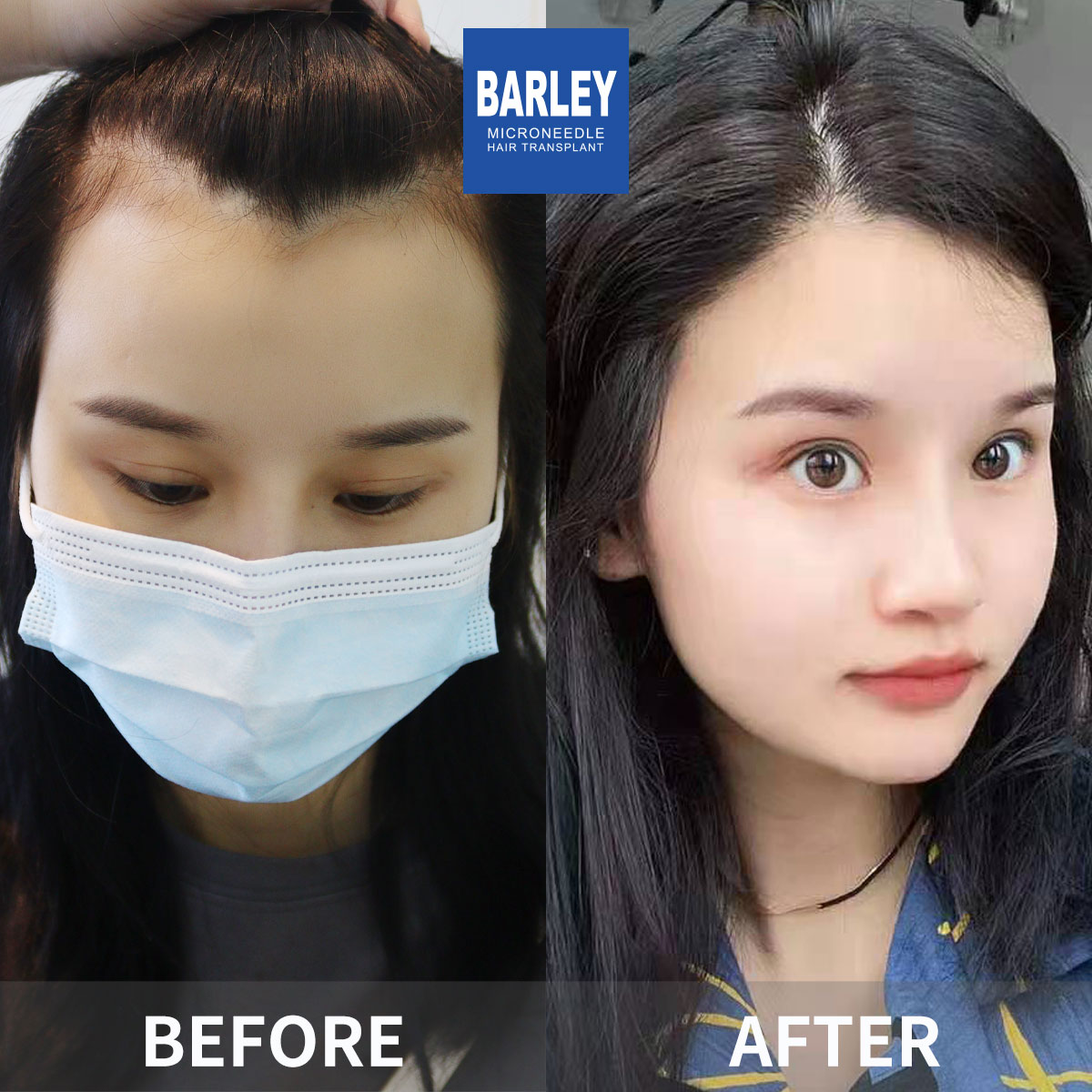 Female hair transplant before and after